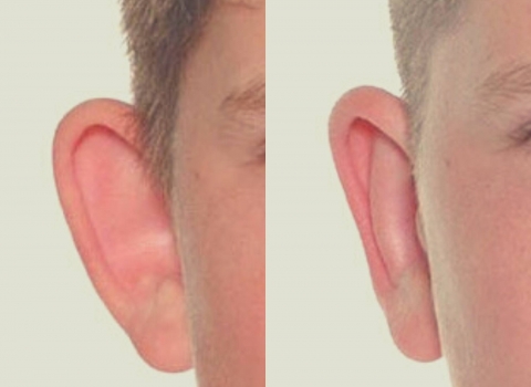 correction of ears otoplasty before and after