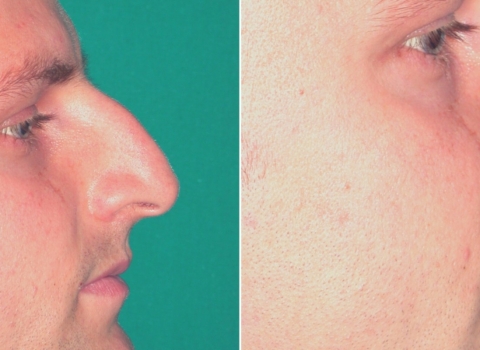 nose surgery rhinoplasty before and after