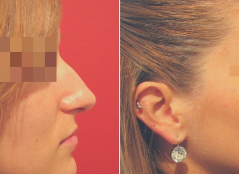 nose surgery rhinoplasty before and after
