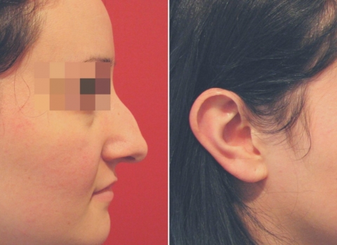 rhinoplasty nose surgery before and after