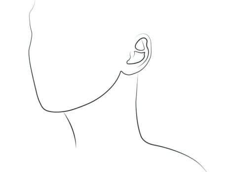 otoplasty ear surgery