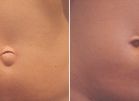 umbilical hernia before and after