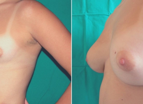 breast asymmetry before and after